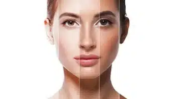 skin whitening in islamabad rawalpindi cost of skin whitening 1